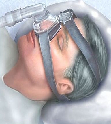 NOVAS TERAPIAS PARA APNEIA OBSTRUTIVA DO SONO